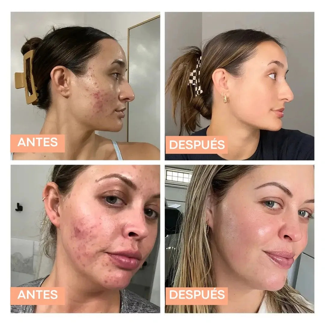 Myo & D-Chiro Inositol – Suplemento para Acné Hormonal